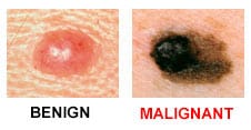 Melanoma