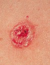 Basal Cell Carcinoma 