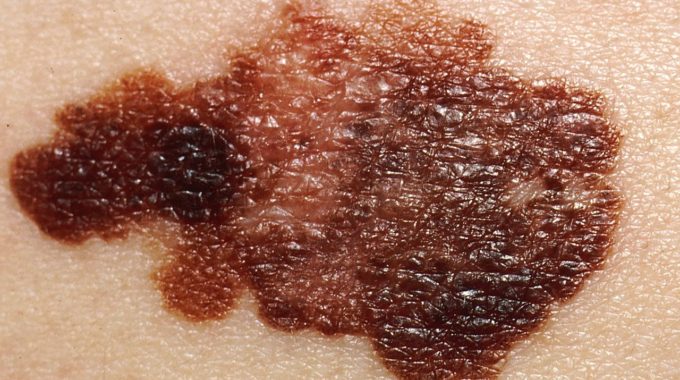 Melanoma