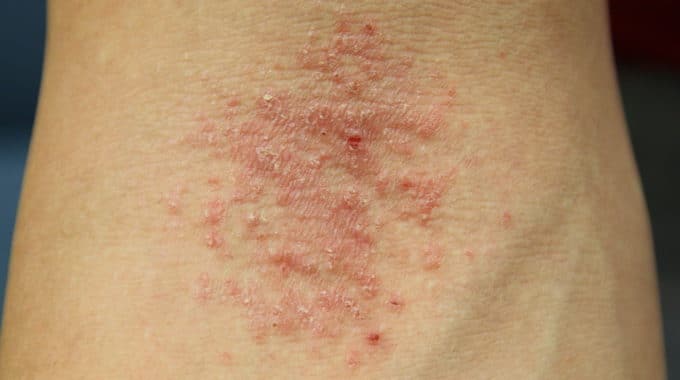 does scratching make hives worse