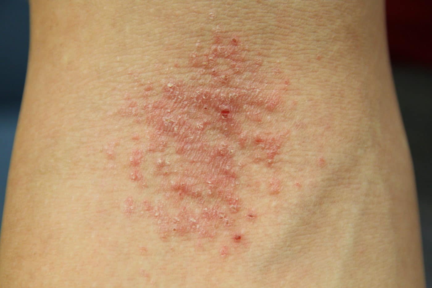 Should I See A Dermatologist Or Allergist For My Rash Massachusetts