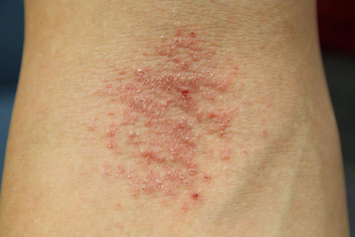 Should I see a Dermatologist or Allergist for My Rash? Massachusetts