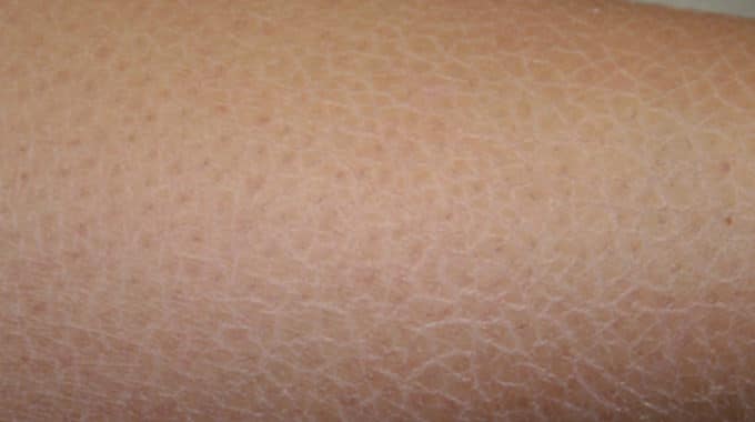 Dry Skin - Xerosis