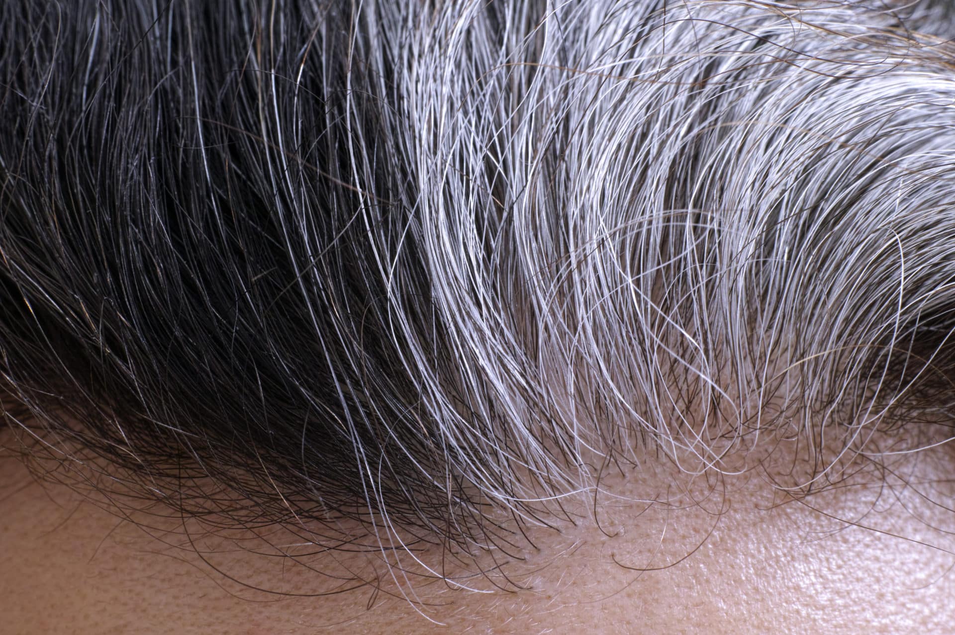 Forever Gray? - Massachusetts Dermatology Associates